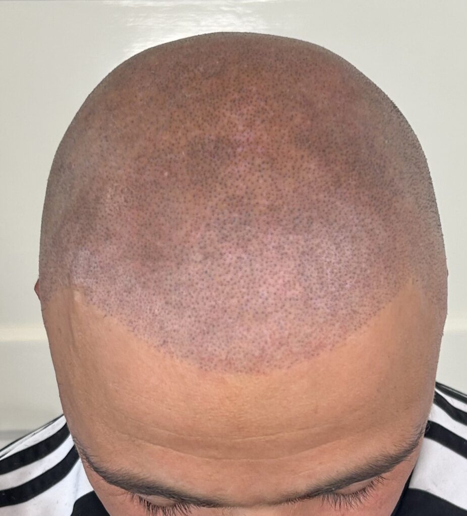 Hair Tattoo Oosterhout, natuurlijke look, na een mislukte haartransplantatie. Geschoren look, shaven look