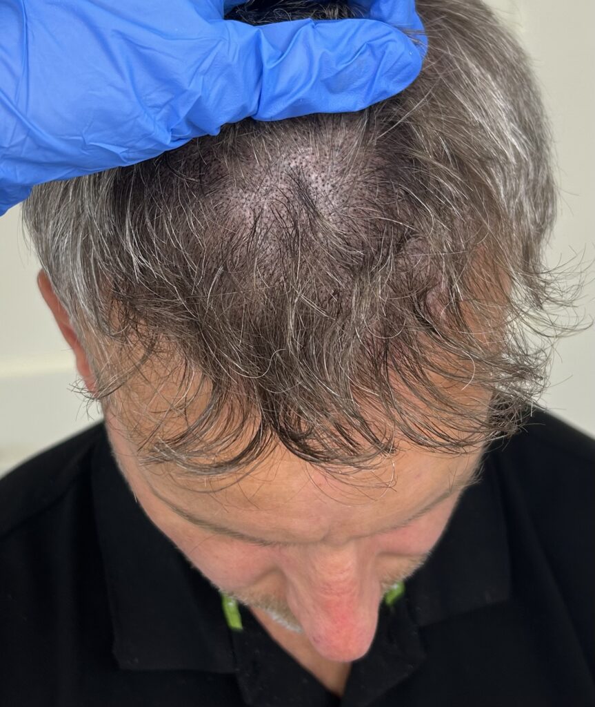 Hair Tattoo Oosterhout, volume behandeling, tussen het haar, haar pigmentatie geplaatst na een te dun uitgevallen haar transplantatie