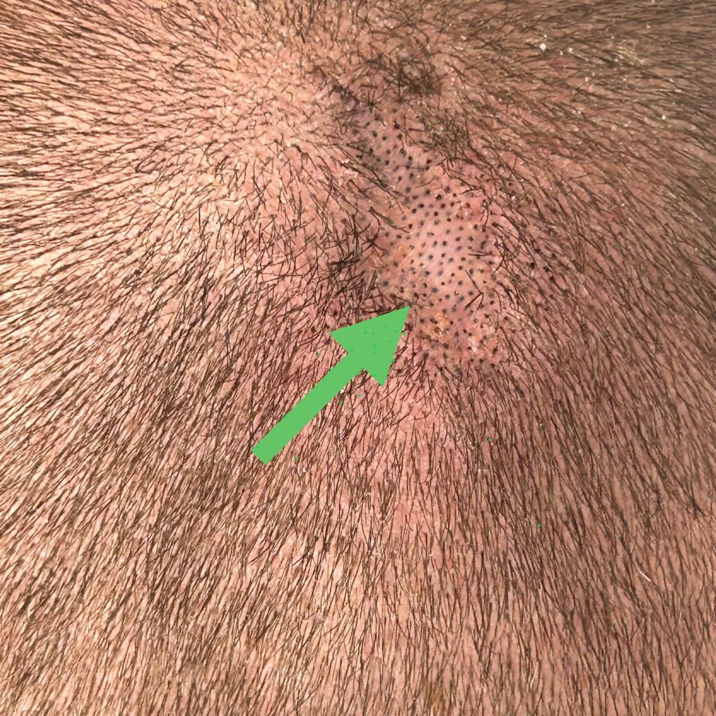 Hair Tattoo Oosterhout, litteken behandeling, geschoren look. Tussen het haar pigmentatie uitgevoerd.