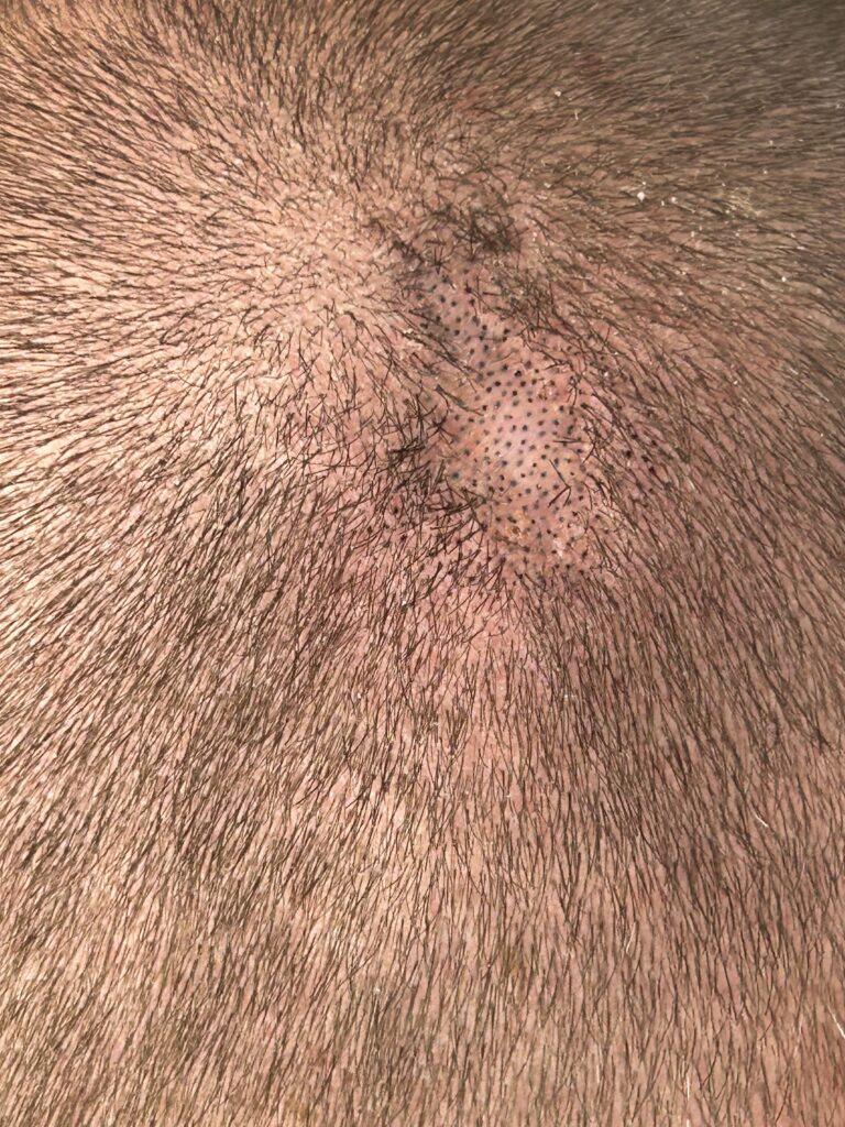 Hair Tattoo Oosterhout, behandeling van een litteken tussen het haar. Advies geschoren look of langer haar van 3 cm voor de beste camouflage.