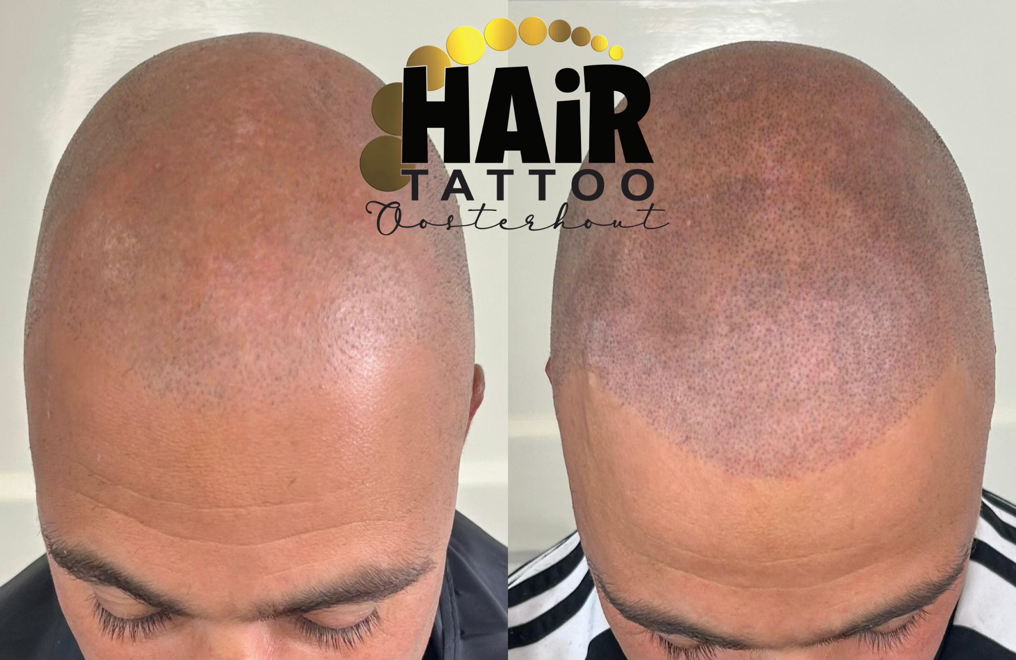 Haar tattoo voorbeeld voor een natuurlijke uitstraling, na mislukte haartransplantatie.