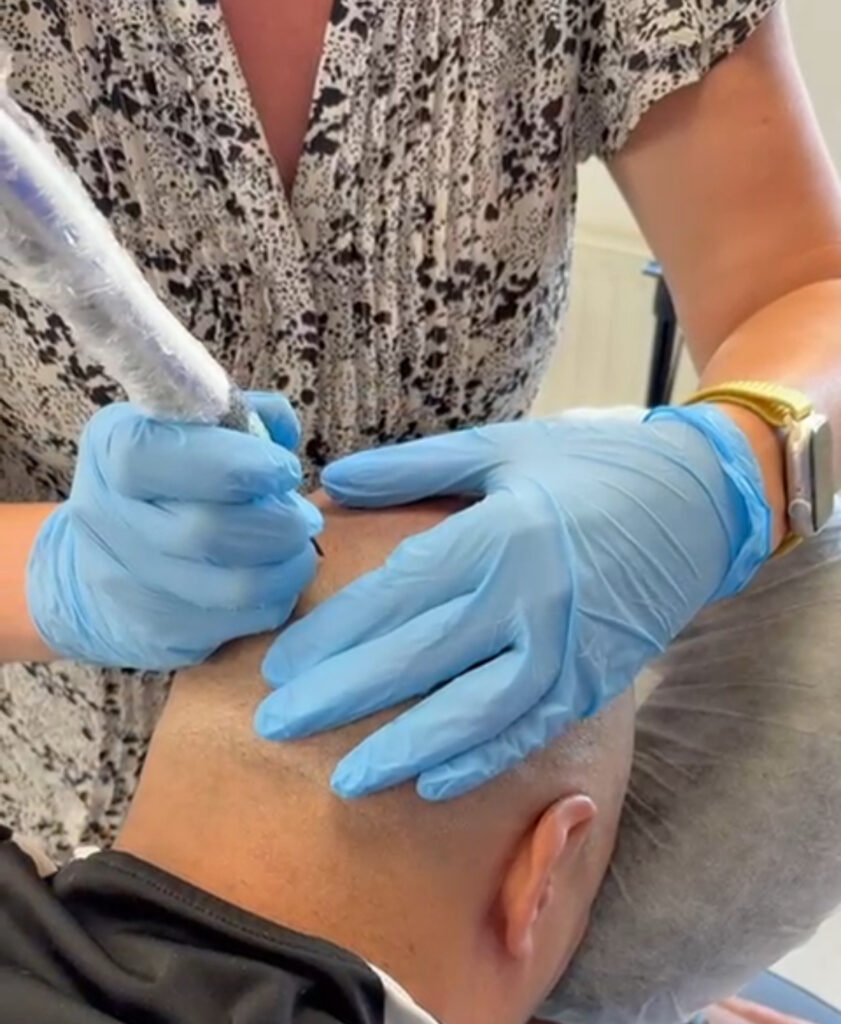 Hair Tattoo Oosterhout. Behandeling van shaven look, geschoren look. Na mislukte haar transplantatie. Tevreden klaar klant.