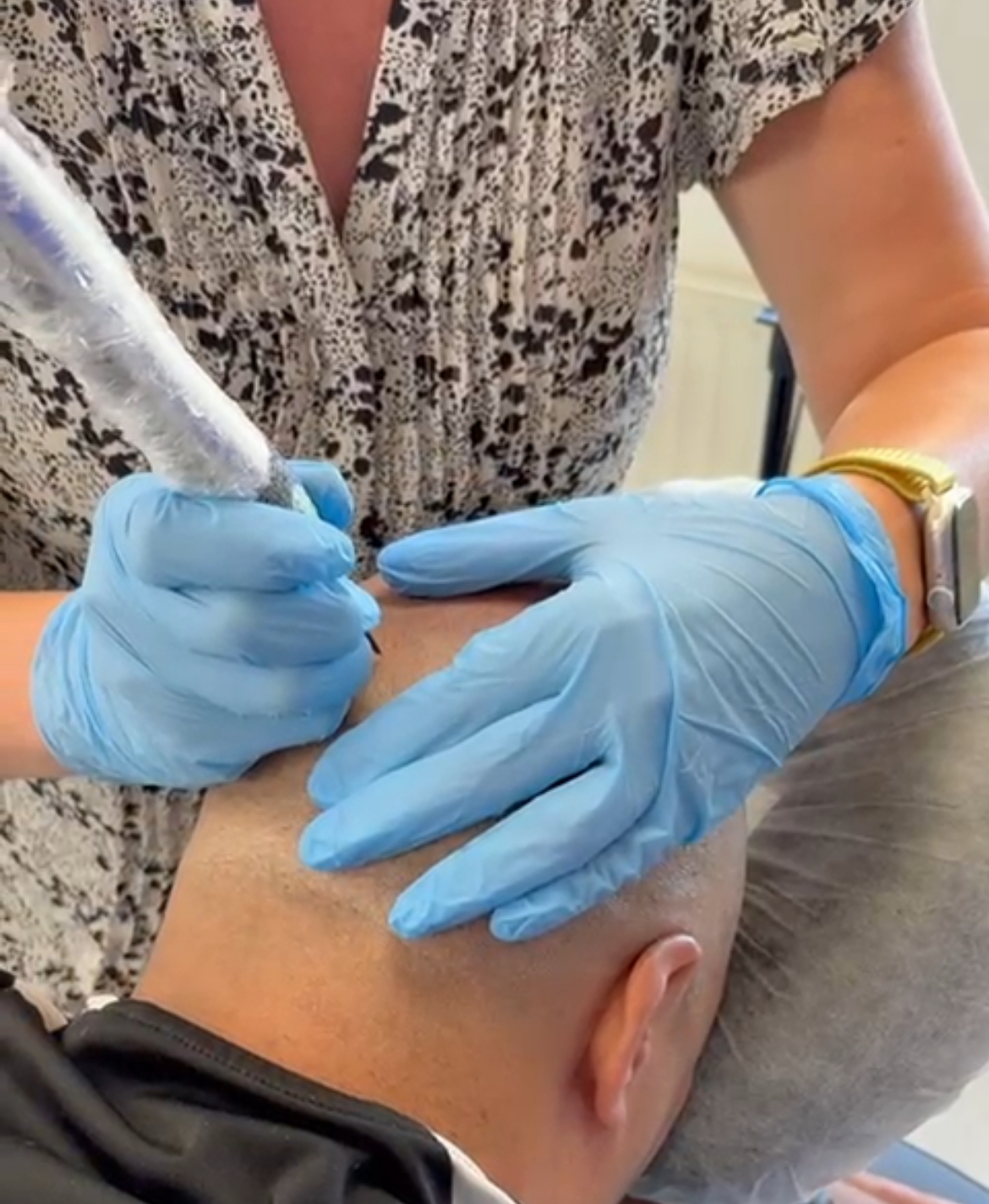 Haar tattoo resultaat op een tevreden klant in Oosterhout. Na een mislukte haartransplantaties