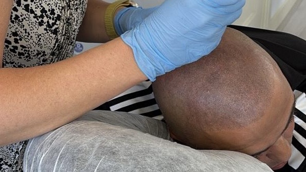 Hair Tattoo Oosterhout, behandeling van een geschoren look, shaven look na 2 mislukte haartansplantaties. Pigmentatie word gezet op het kale hoofd en secuur loop het over in het nog eigen bestaande haar. Haarlijn is hersteld, deze meneer wilde een wat hardere haarlijn in plaats van een natuurlijke. 